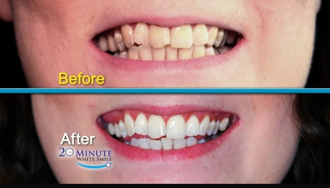 Blanqueador Dental ✨¡En 20 Minutos!🦷
